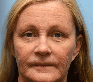 BeeBotox| Botox Effect Rimpelverwijdering Crème